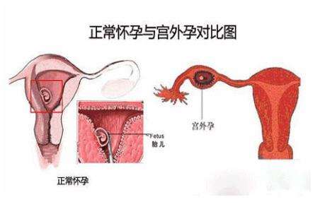 宫外孕七个月,宫外孕七个月，了解、应对与心理调适