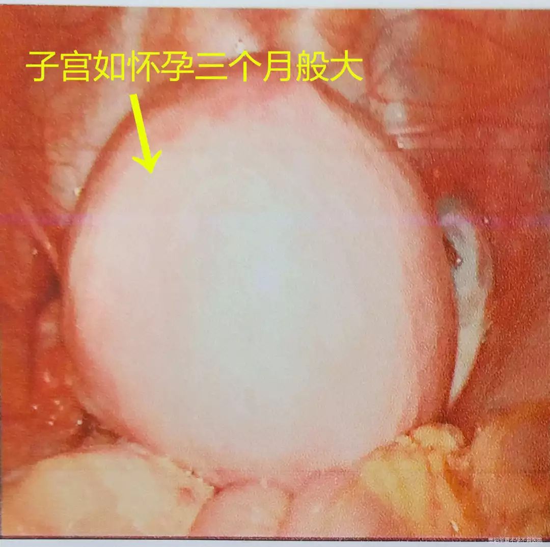 怀孕3个月子宫有多大,怀孕三个月子宫大小详解