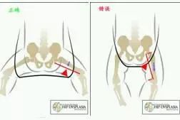 6个月宝宝臀纹不对称,关于六个月宝宝臀纹不对称的探讨